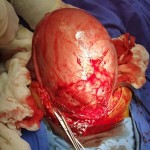 foto 1 Feto In Utero (2)